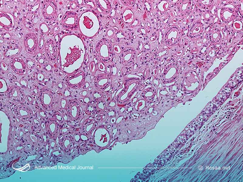 سونوگرافی برای تشخیص نفروکلسینوز