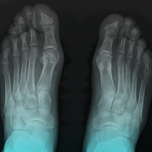 استئولیز و ساییدگی استخوان‌ها