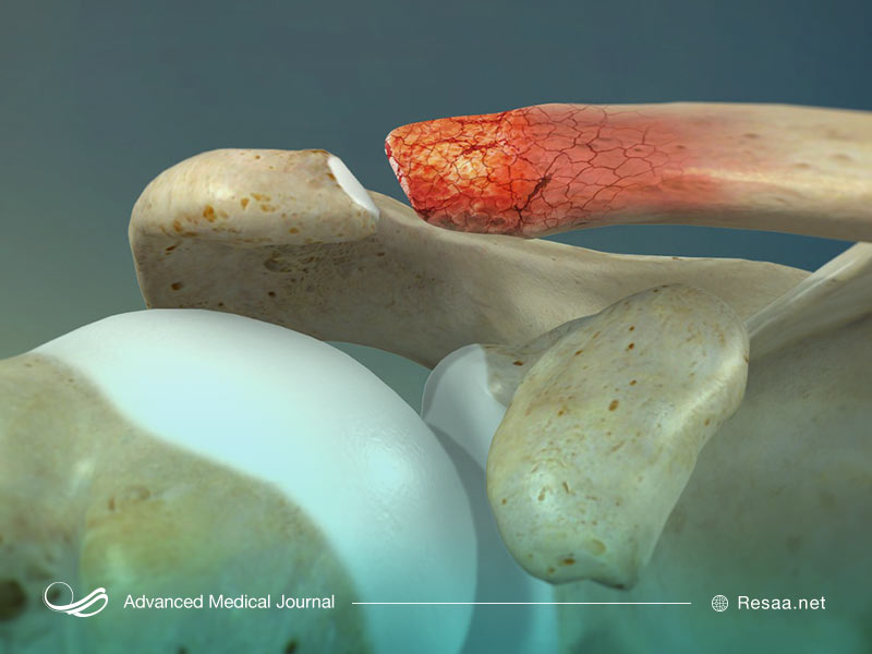 استئولیز سبب ضعیف شدن استخوانها میشود.