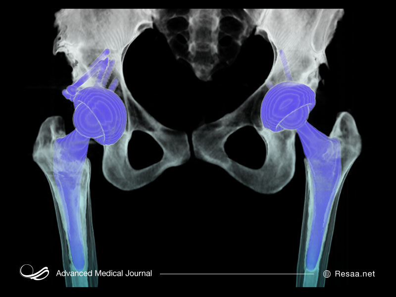 تصویر ایکس ری استخوان لگن