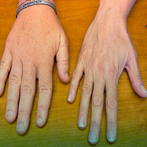 آکرومگالی چیست