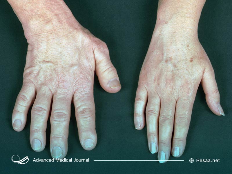 آکرومگالی نوعی بیماری هورمونی است