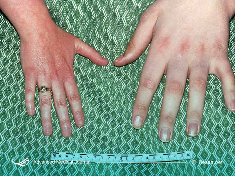 آکرومگالی و تورم انگشتان دست و پا