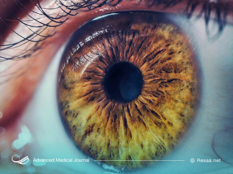 سندروم آلپورت همچنین روی بینایی فرد نیز اثرگذار است.