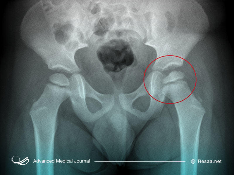 دیسپلاژی و خطر ابتلا به سرطان