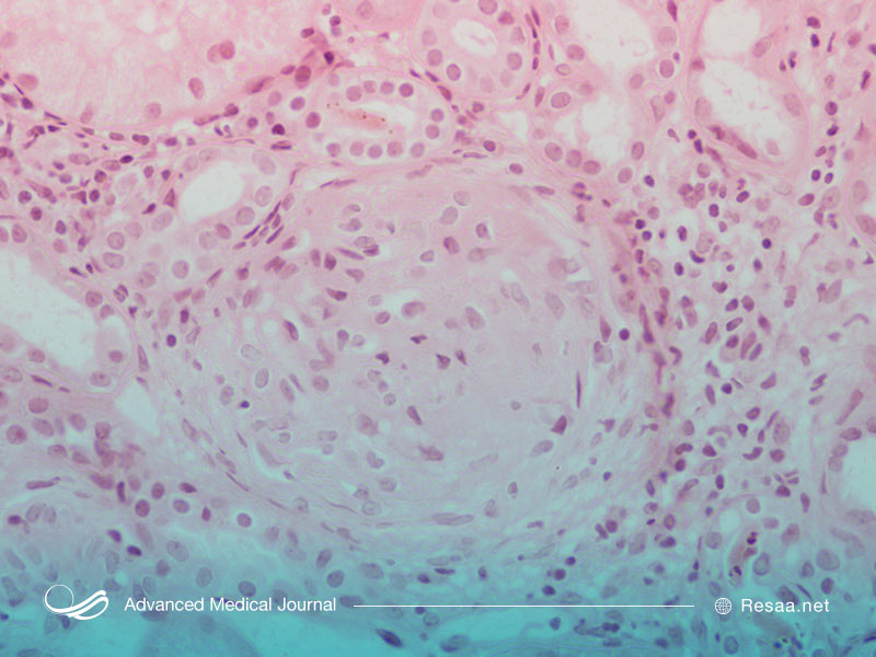 گلومرولونفریت التهاب گلومرولهای کلیه است.