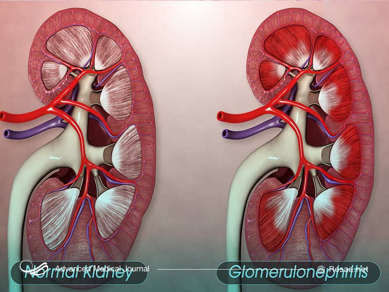 عفونت باکتریایی سبب پیلونفریت میشود.