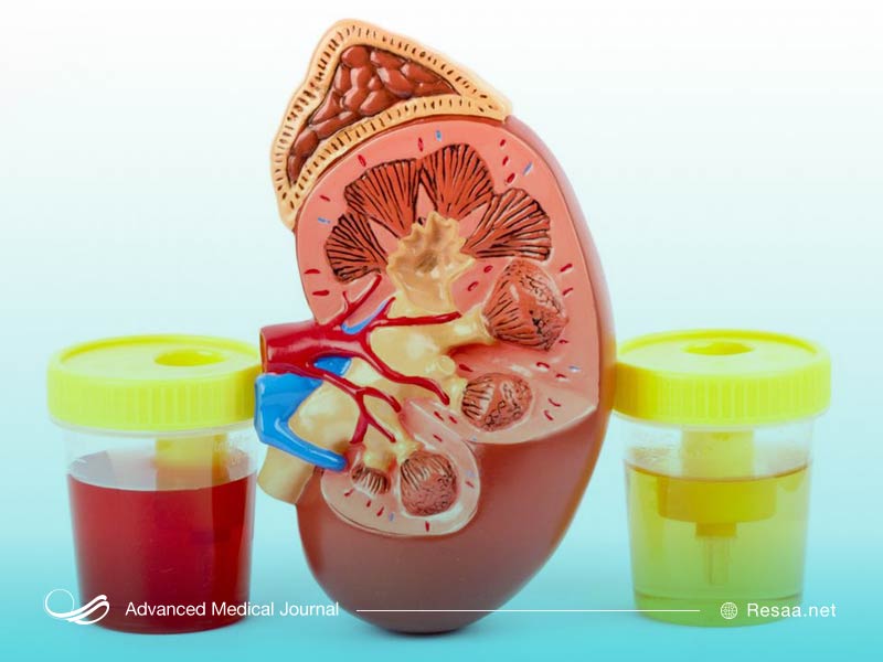 GN در مواردی سبب نارسایی کلیه میشود.