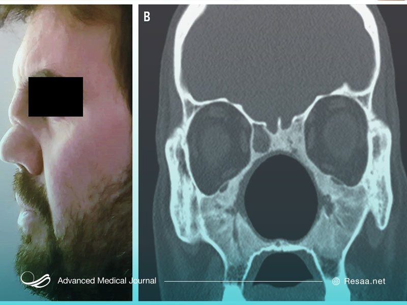 گرانولوماتوز نوعی التهاب اطراف رگهای خونی ایجاد میکند.