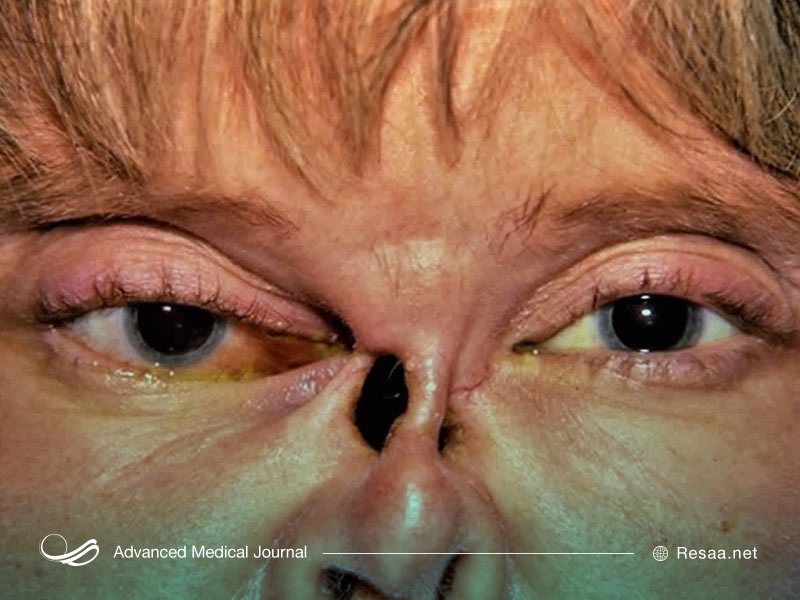 گرانولوماتوز سبب عوارض مختلفی در بدن میشود.