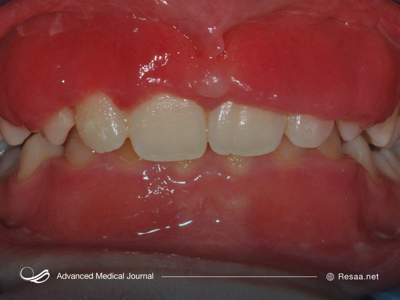 گرانولوماتوز و التهاب بافتها