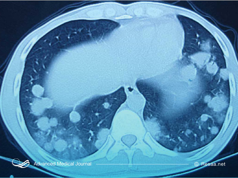 تصویربرداری پزشکی برای تشخیص گرانولوماتوز