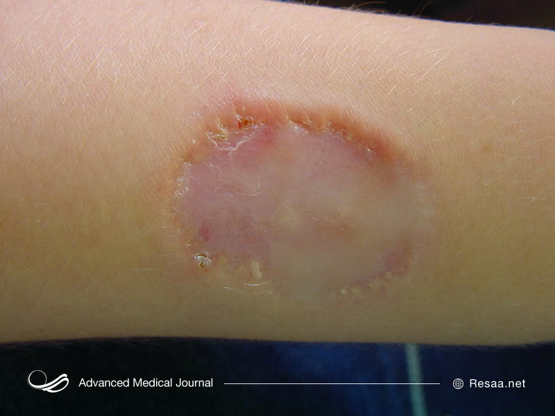 ترومبوز و زخمهای پوستی از علائم گرانولوماتوز است.