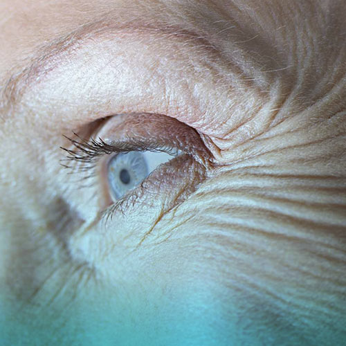 کراتوپاتی باند چه بیماری است