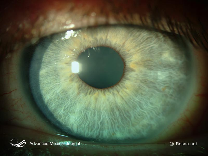 سوزش چشم در کراتوپاتی