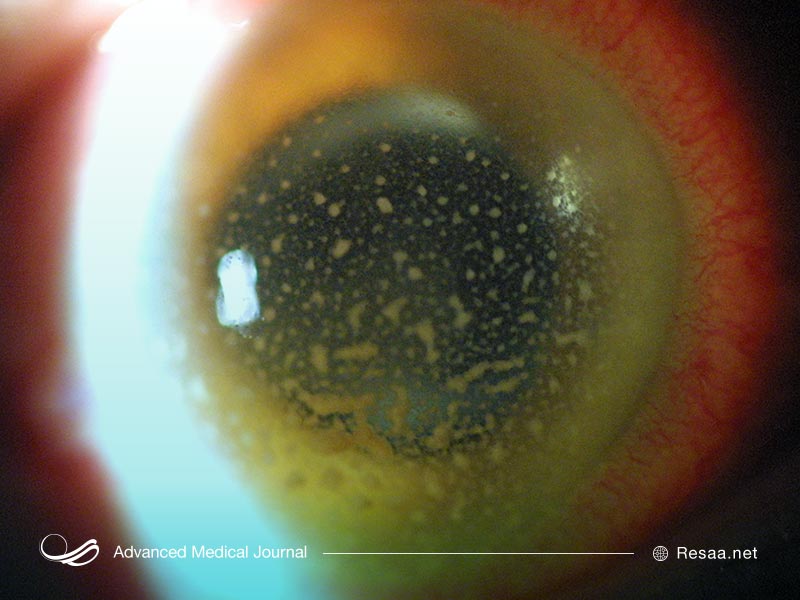 ارتباط کراتوپاتی با سایر بیماریها