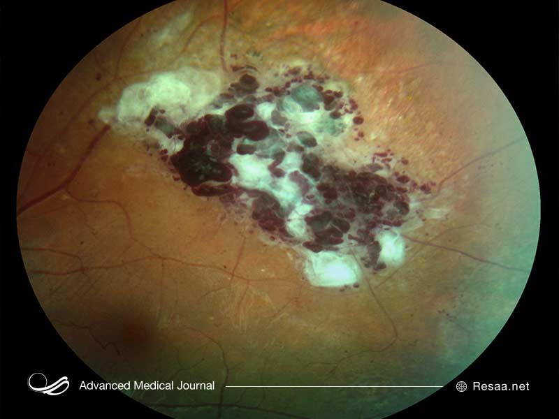 بیماری VHL ممکن است سبب بروز سرطان‌ شود.
