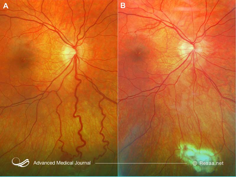 برای درمان VHL باید تحت نظر پزشک باشید.
