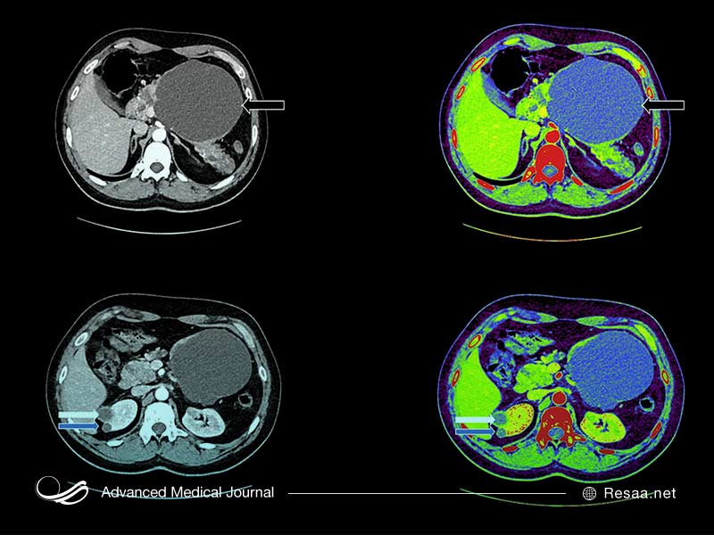 ضایعات عصبی ناشی از VHL را می‌توان درمان کرد.