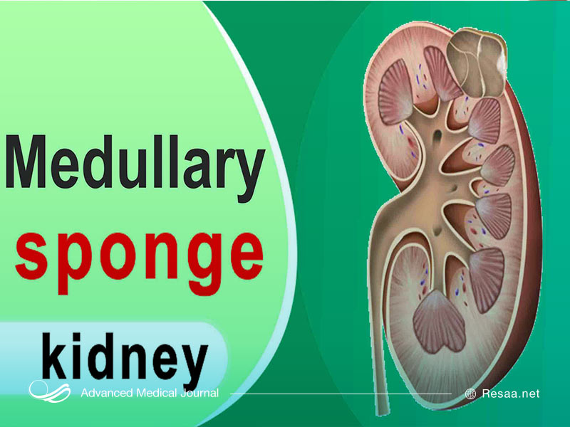 کلیه اسفنجی مدولار اختلالی نادر است.