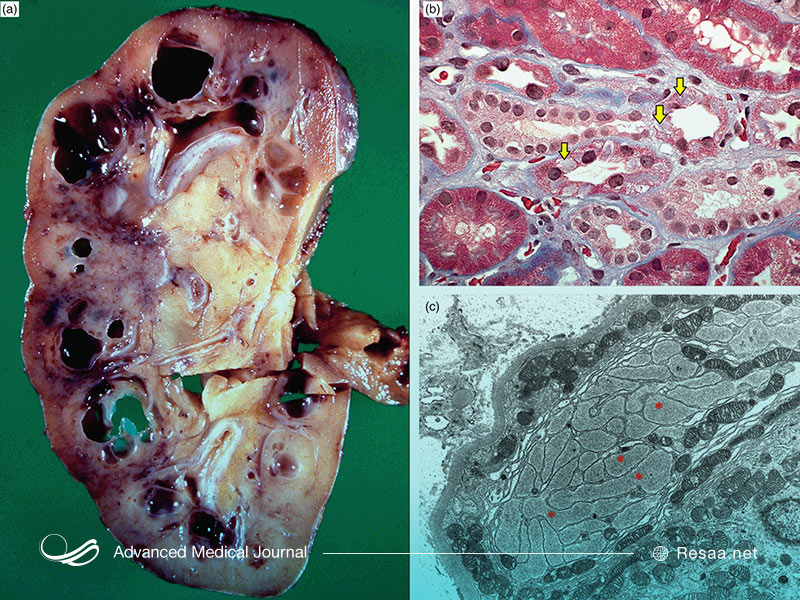 تصویری از کلیه اسفنجی مدولار