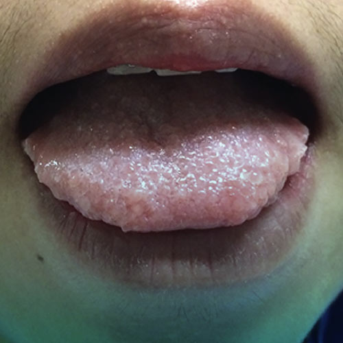 سندروم نئوپلازی چیست