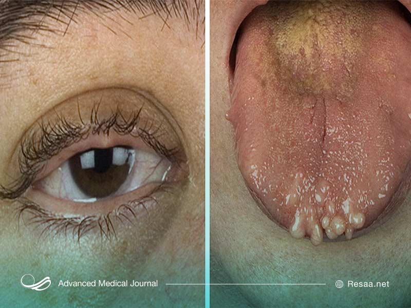 سندروم نئوپلازی مربوط به غدد درون‌ریز است.