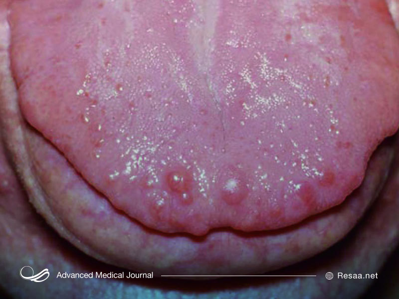 برای درمان نئوپلازی از جراحی یا دارودرمانی استفاده می‌شود.