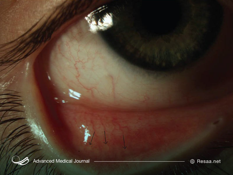 آزمایش ژنتیکی به منظور تشخیص نئوپلازی