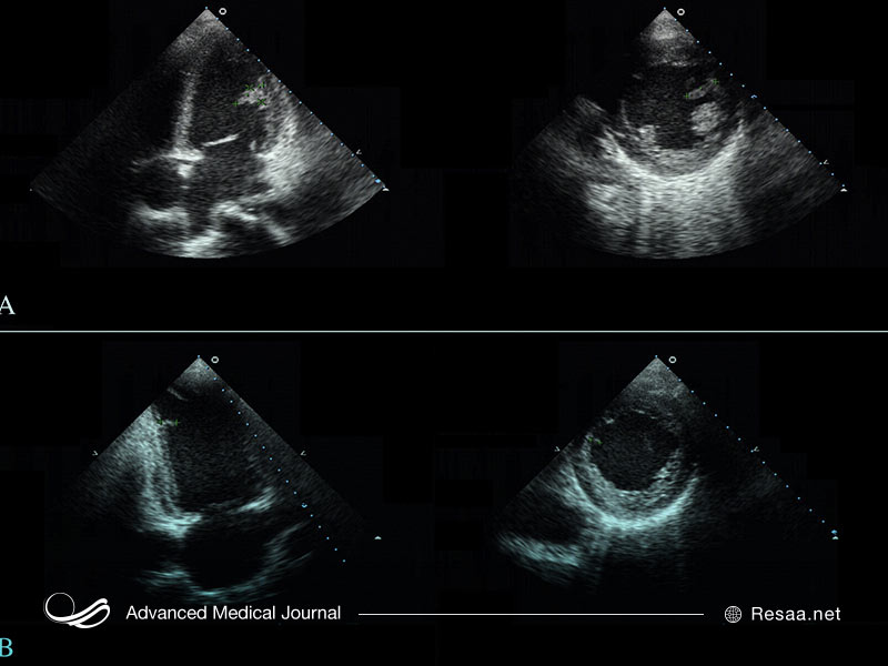 فئوکروموسیتوما نوعی تومور غیر سرطانی در کلیه است.