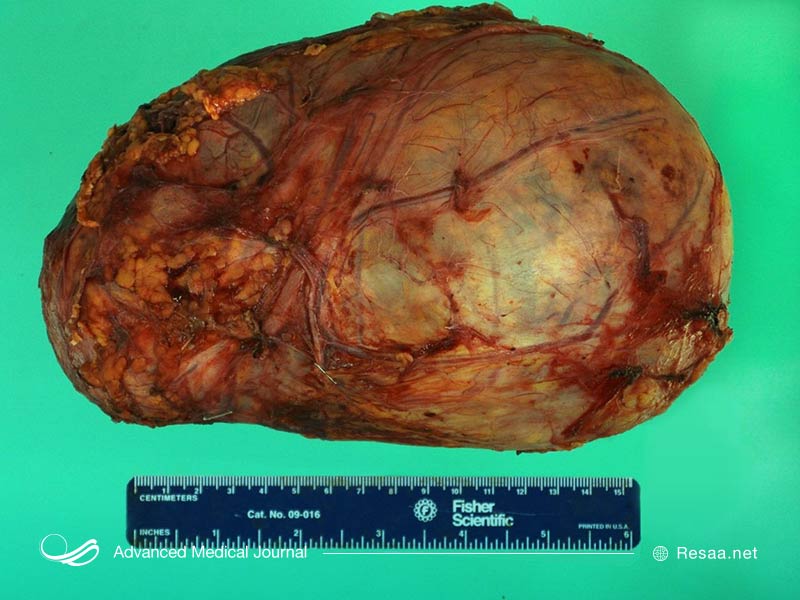 تومورهای فئوکروموسیتوما اغلب سرطانی نیستند.