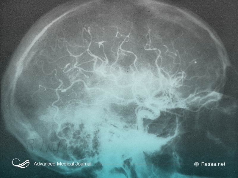 عوارض متعدد بیماری فئوکروموسیتوما