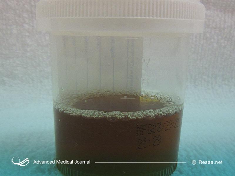 تجزیه بافت‌های استخوانی عضلانی در بیماری رابدومیولیز