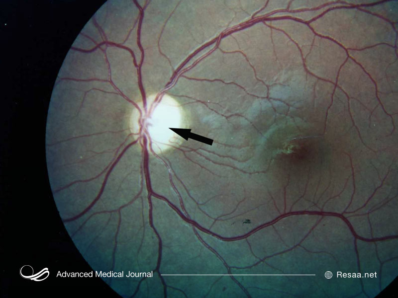 جهش ژنی سبب بروز ولفرام می شود.