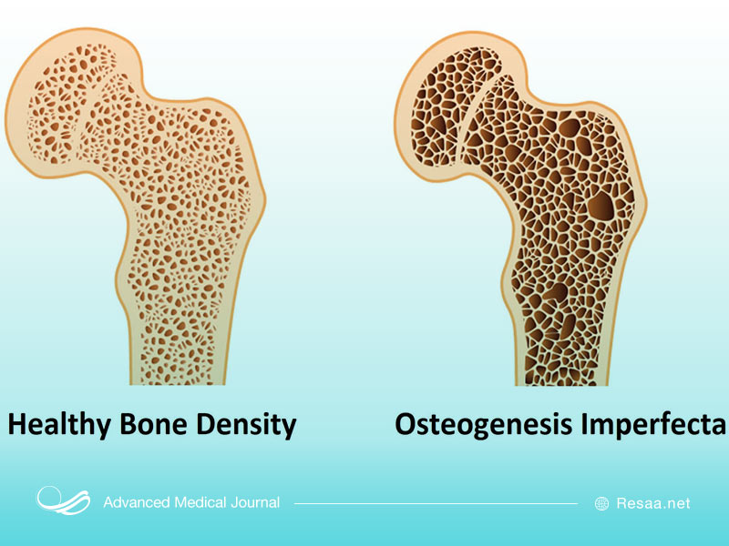 مقایسه استخوان سالم و دچار اختلال