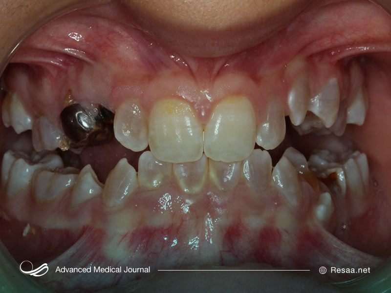 تصویر دندانهای فرد مبتلا به استخوان زایی