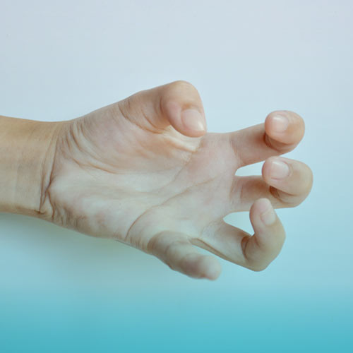 دیستونی بیماری مغزی حرکتی می باشد.