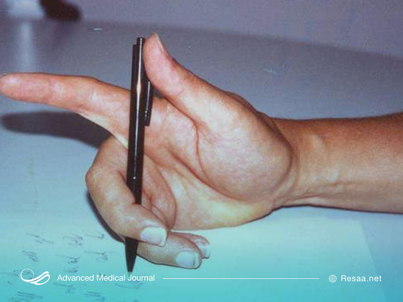 دیستونی درجات مختلفی دارد که افراد را درگیر خود می‌کند.