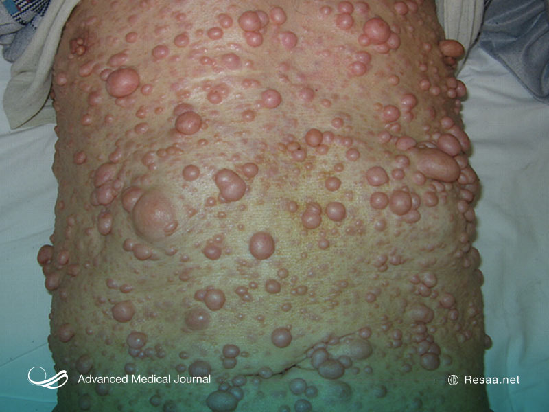 اختلال عصبی