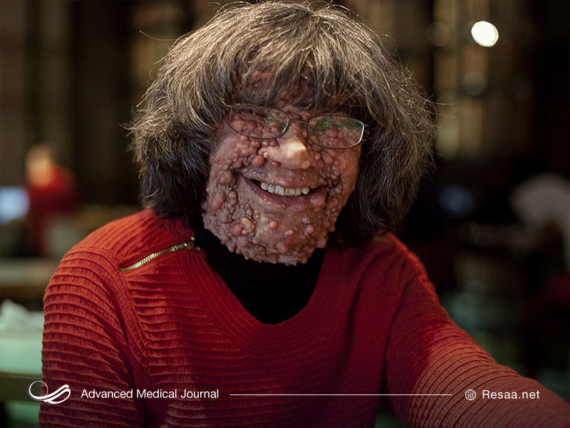 تصویر فرد مبتلا به نوروفیبروماتوز