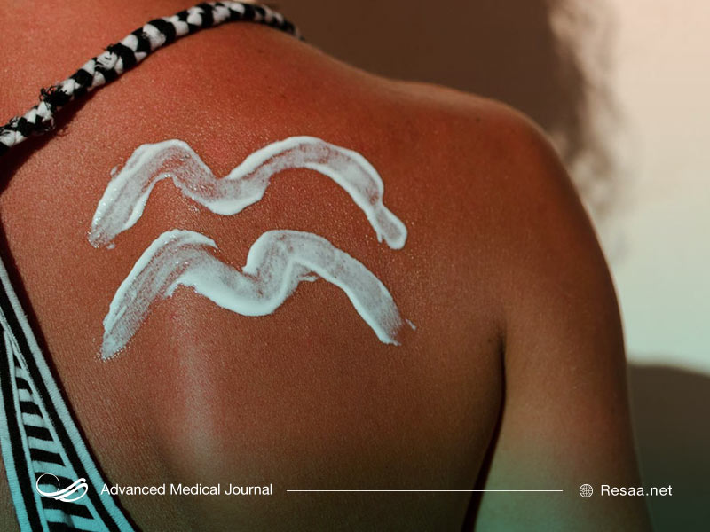 آفتاب سوختگی می‌تواند سبب مشکلات عدیده‌ای برای پوست شود.