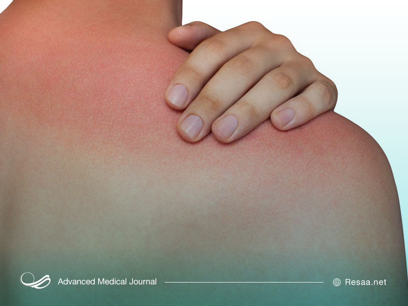 مراقبت از پوست در برابر آفتاب سوختگی