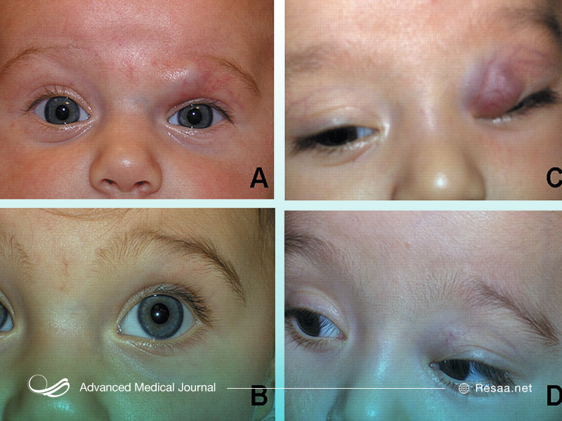 مصرف پروپانول در کودکان