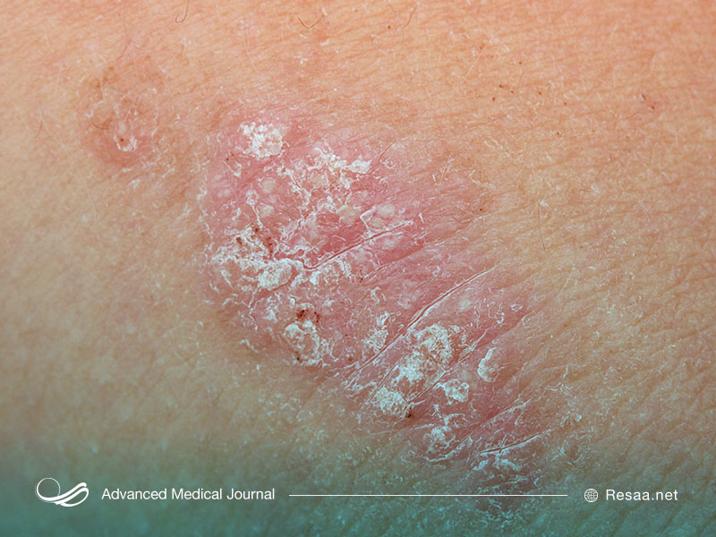 بتامتازون "betamethasone" چیست؟