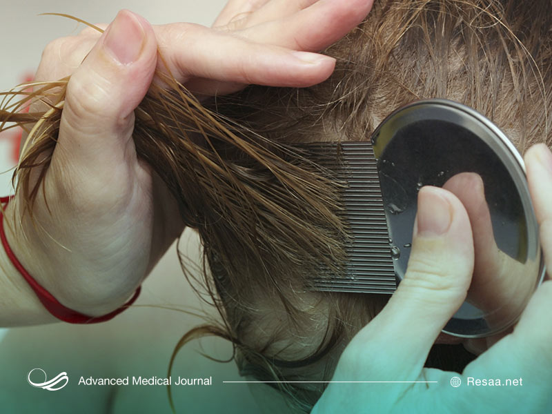 نحوه انتشار شپش سر را بدانید