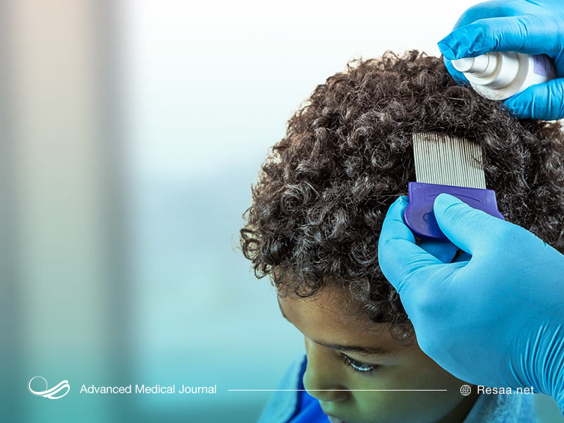 داروهای تجویزی جهت درمان شپش سر