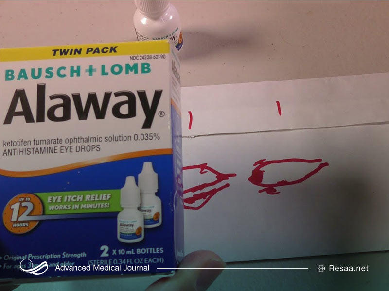 قطره چشمی کتوتیفن ممکن است عوارض جانبی ایجاد کند.