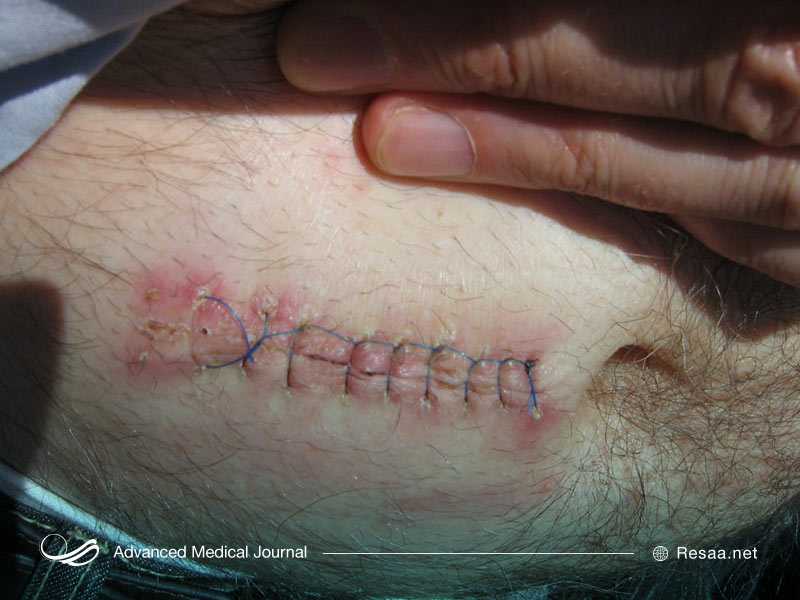 بریدگی عمیق یا صدمات بسیار شدید