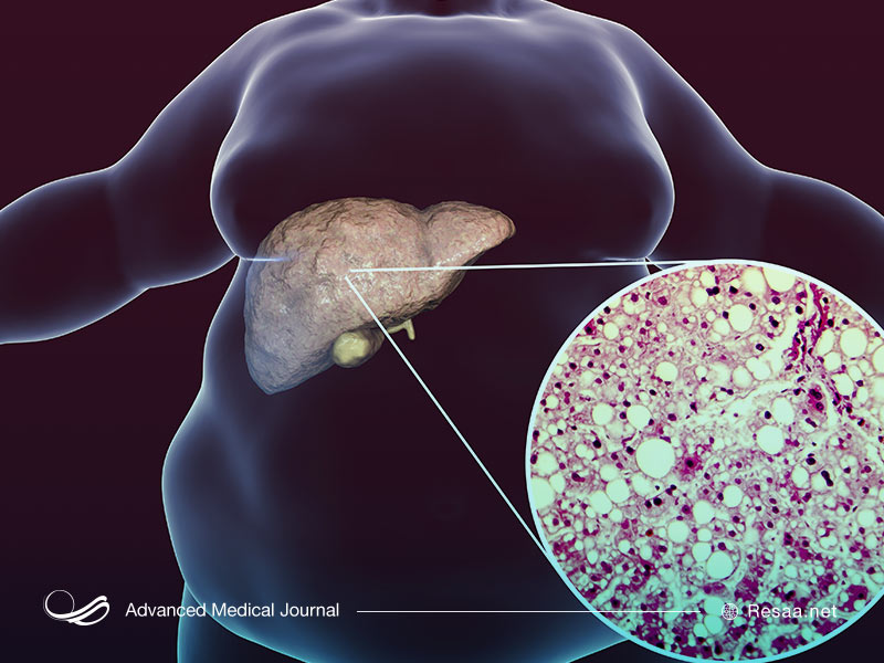 بیماری کبد چرب زمانی رخ می‌دهد که بیش از 5 درصد چربی، در کبد وجود داشته باشد.