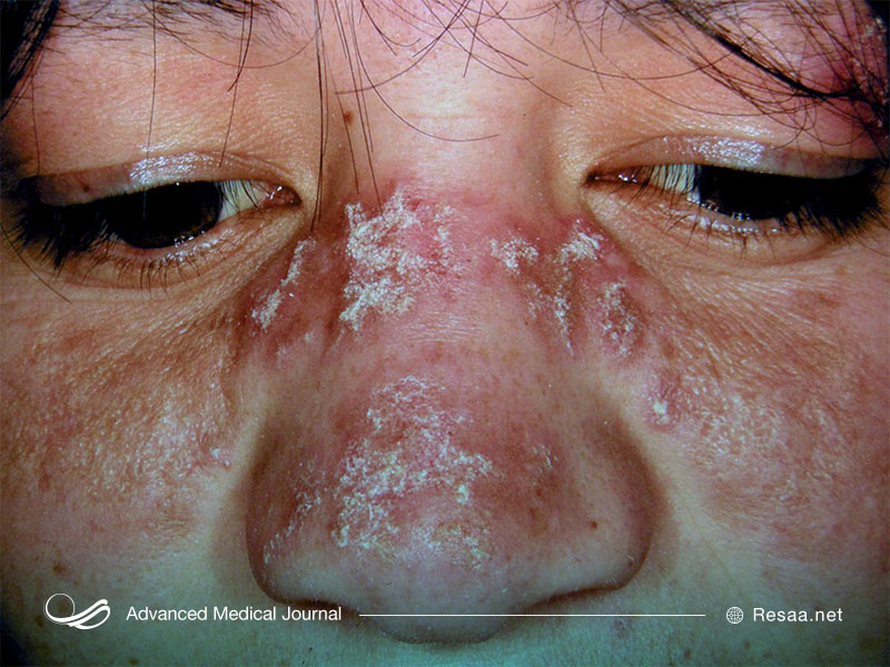 لوپوس اریتماتوز سیستمیک